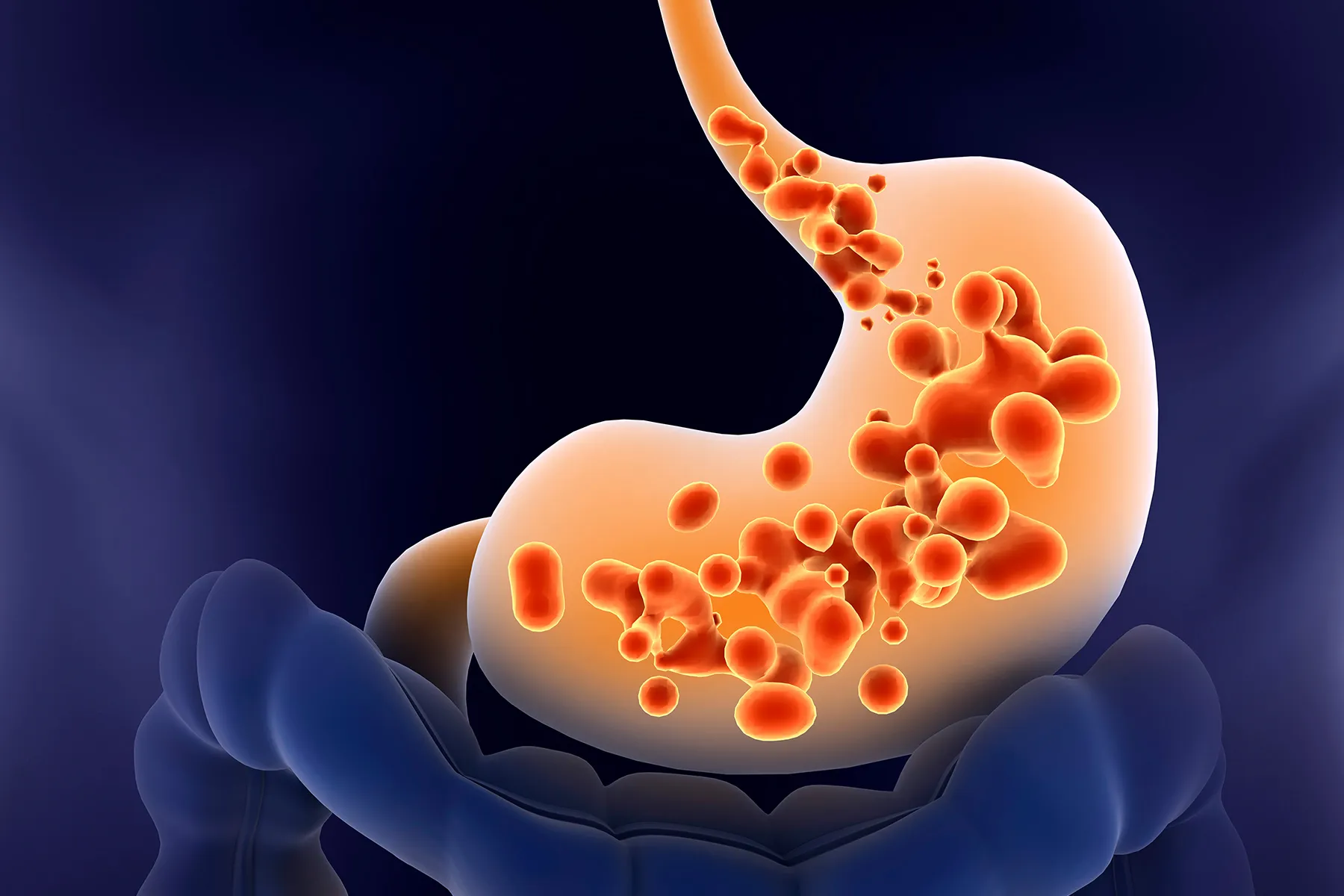 gastroesophageal reflux disease